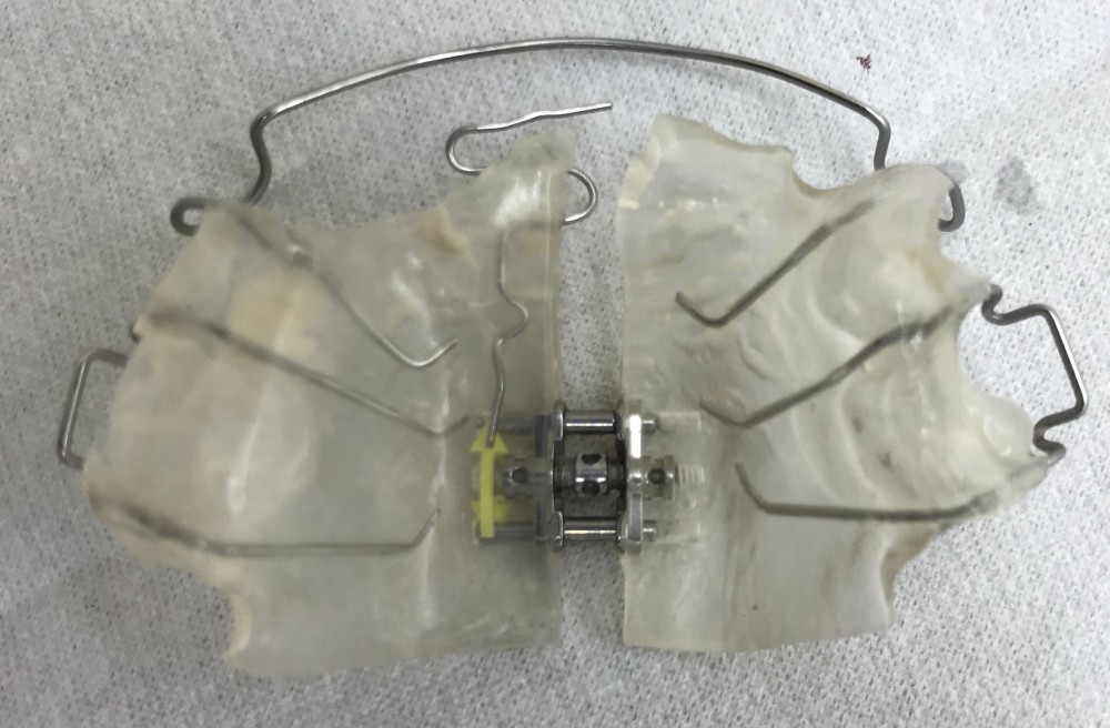 【混合歯列期の床矯正】