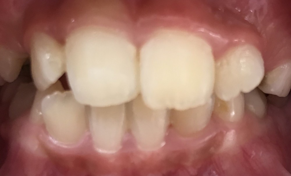 【混合歯列期の床矯正】