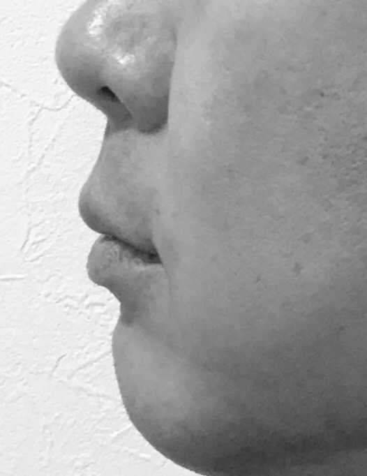 【歯を抜かない歯列矯正のリスク】