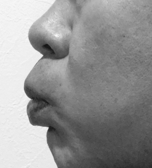 【歯を抜かない歯列矯正のリスク】