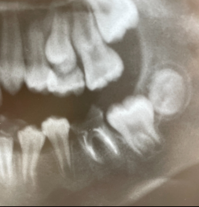10才で永久歯(6才臼歯)を抜歯した症例の5年経過