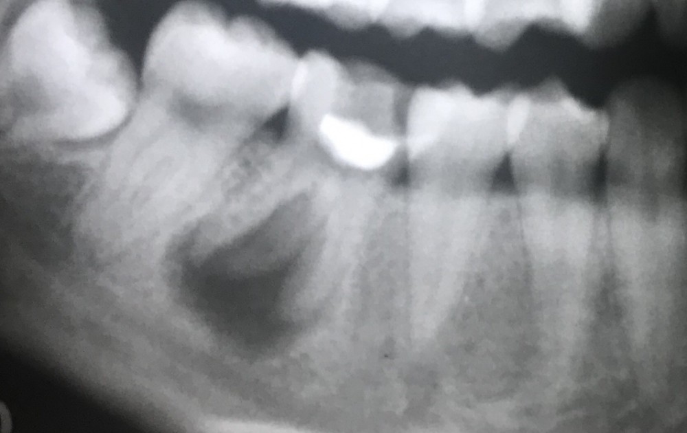 【歯内療法9年経過症例】