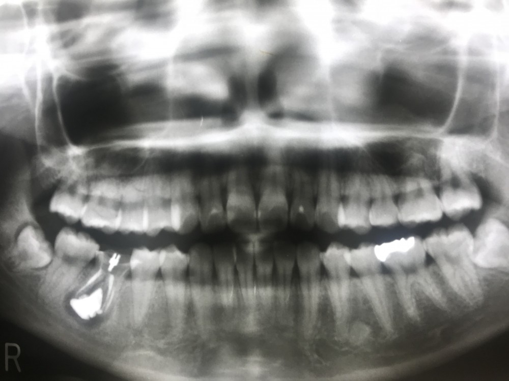 【歯内療法9年経過症例】