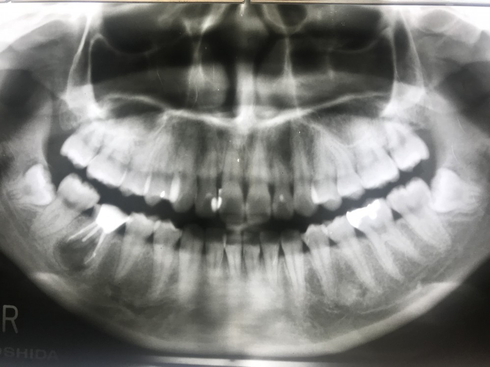 【歯内療法9年経過症例】