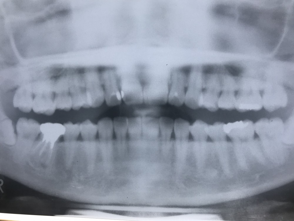 【歯内療法9年経過症例】