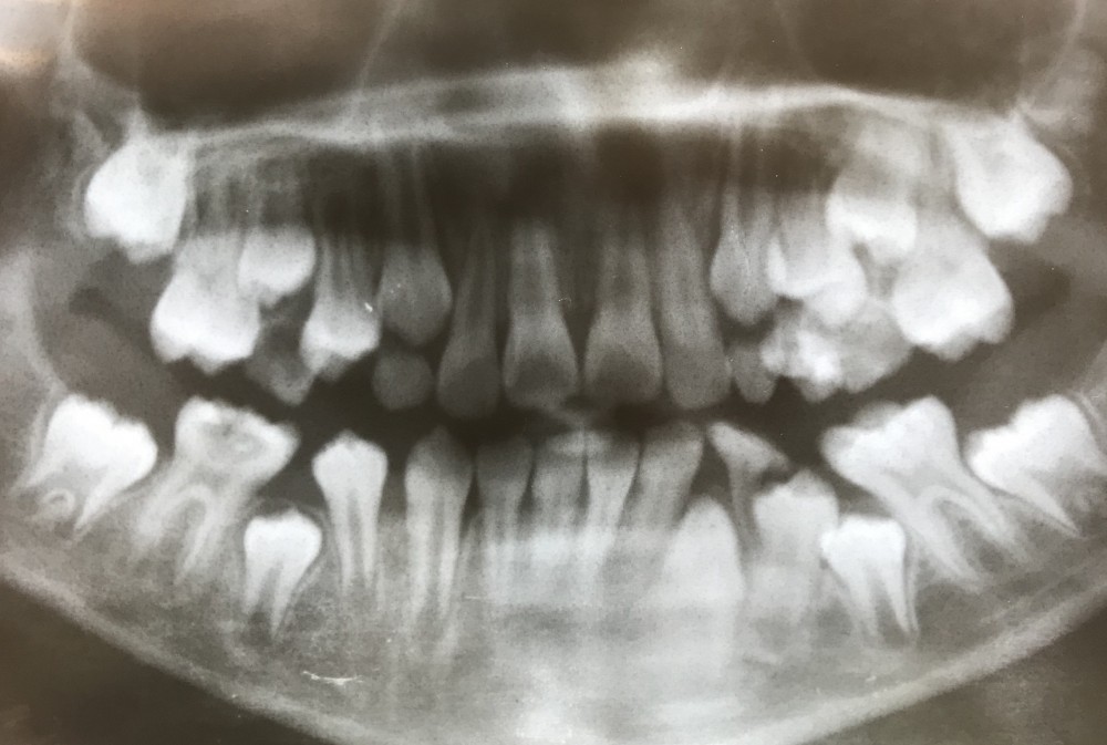 学童【下顎第一大臼歯の抜髄】