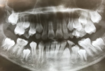 学童【下顎第一大臼歯の抜髄】