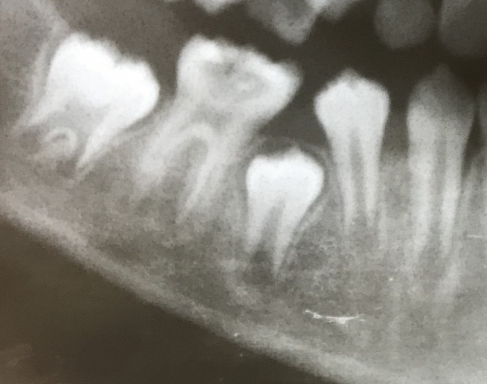 学童【下顎第一大臼歯の抜髄】