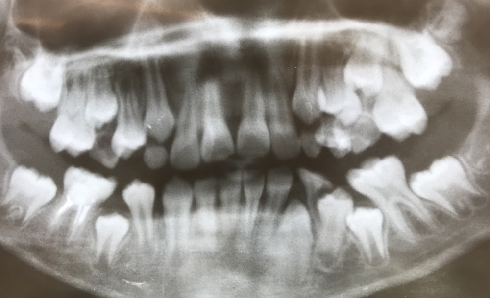 学童【下顎第一大臼歯の抜髄】