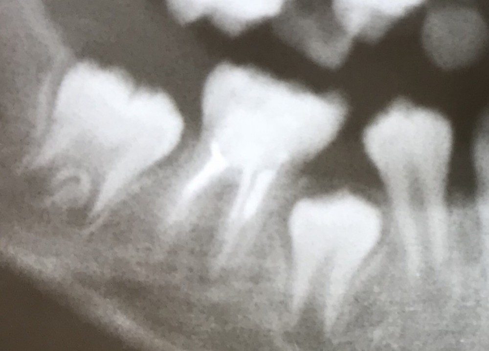 学童【下顎第一大臼歯の抜髄】