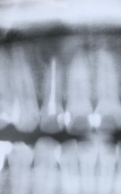 【歯列矯正術前う蝕処置】
