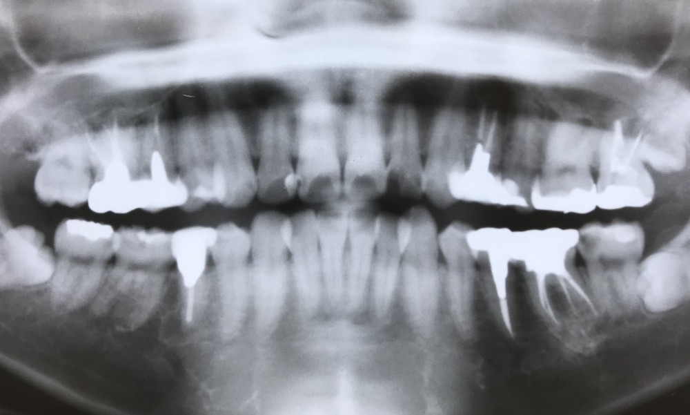 【歯列矯正術前う蝕処置】