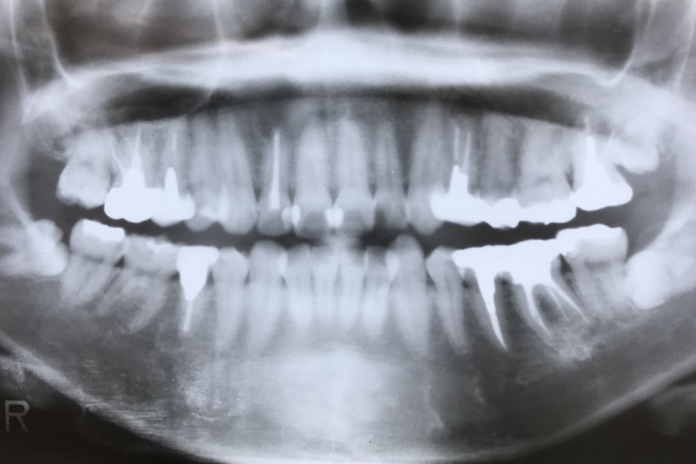【歯列矯正術前う蝕処置】