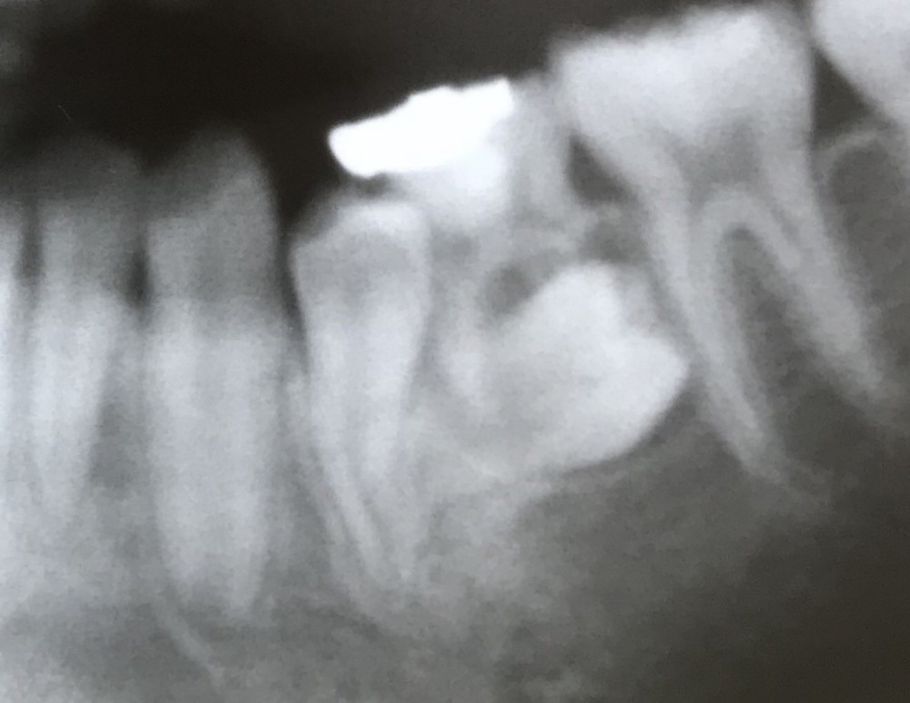 【乳歯抜歯の難しいケース その1】