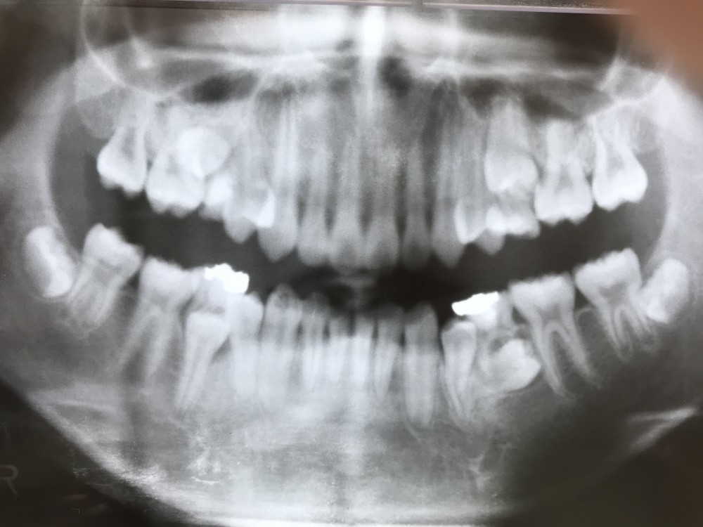 【乳歯抜歯の難しいケース その1】