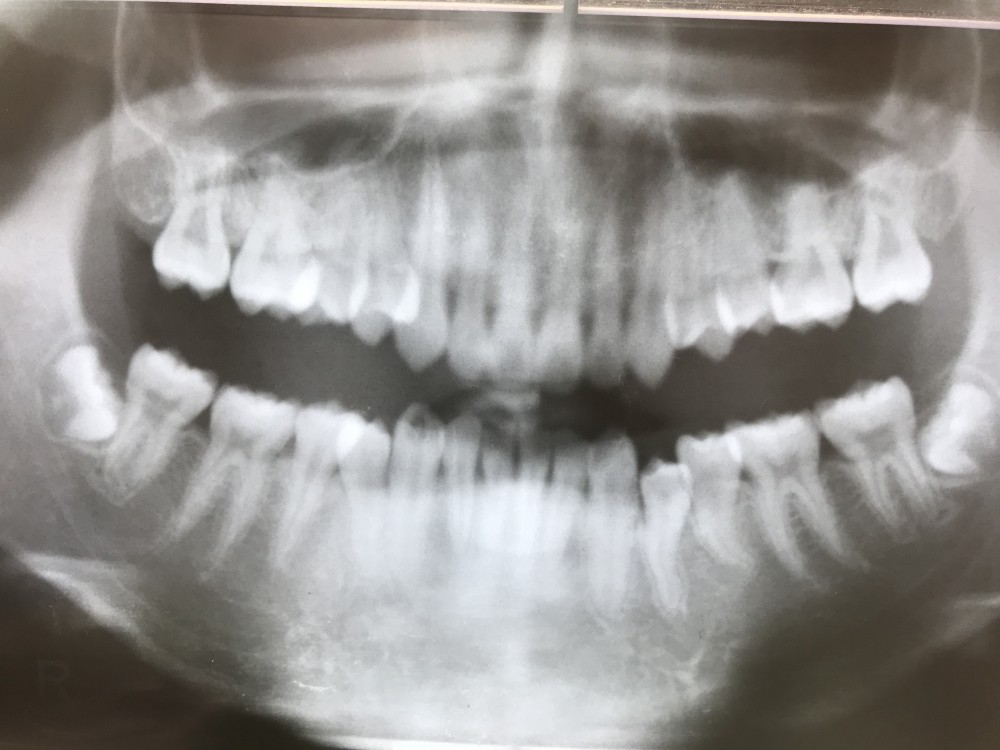 【乳歯抜歯の難しいケース その1】