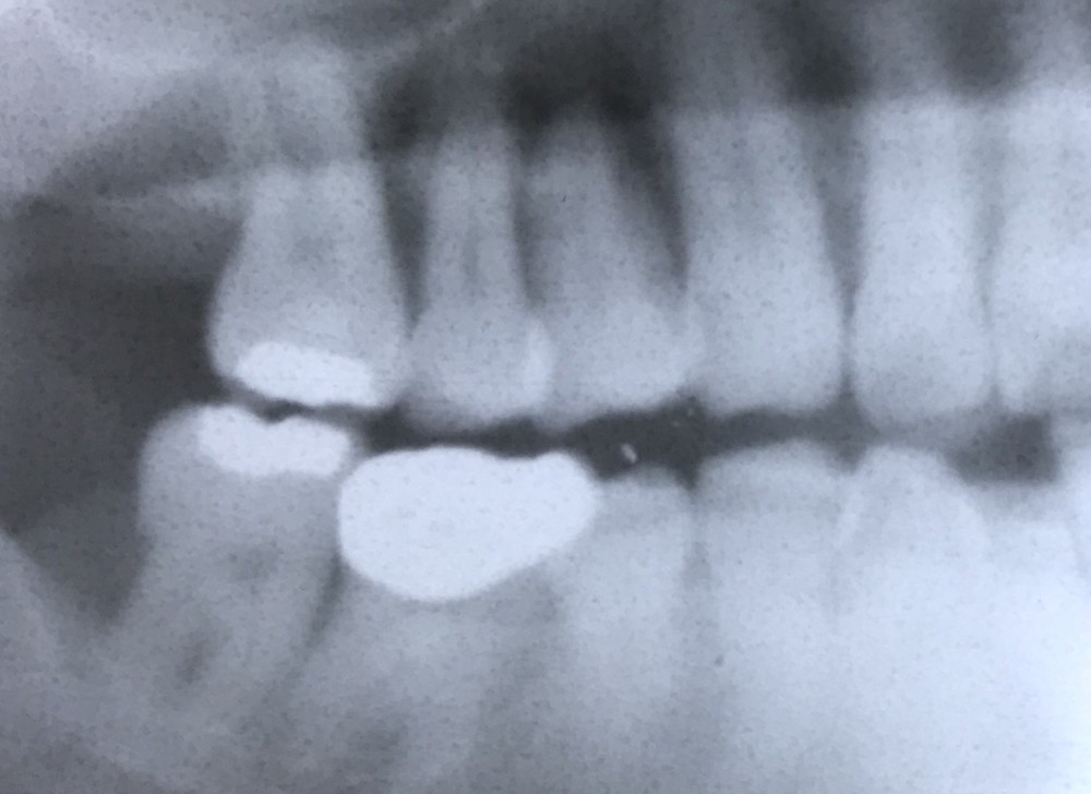 もしも歯を抜くことになったら
