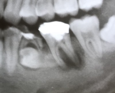 【乳歯抜歯の難しいケース その2】