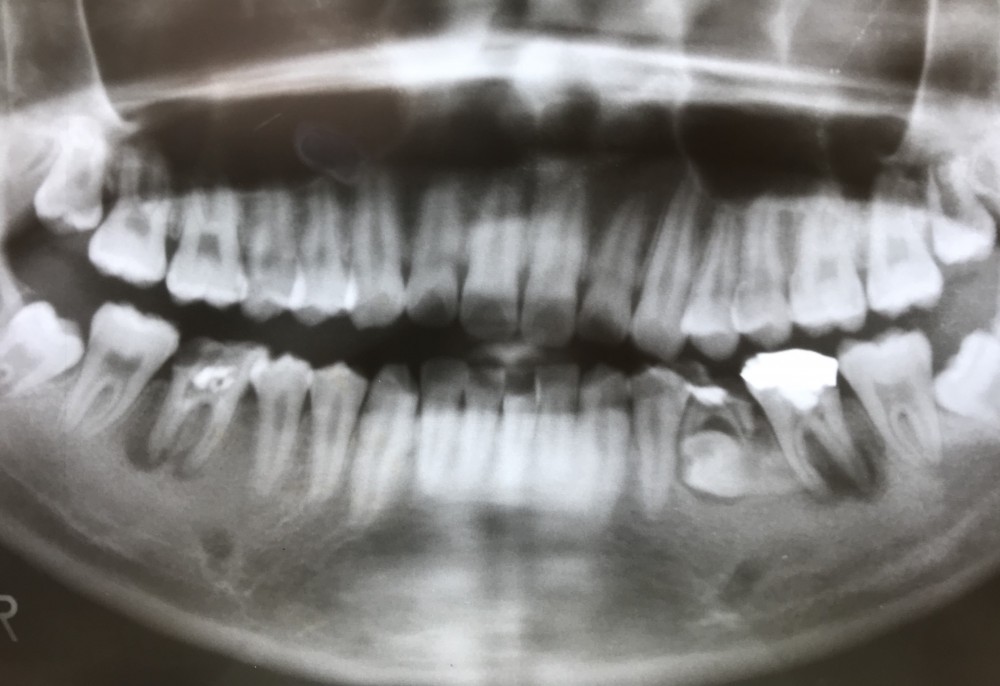 【乳歯抜歯の難しいケース  その2】