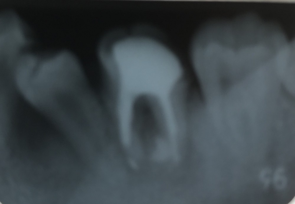 【乳歯抜歯の難しいケース  その2】