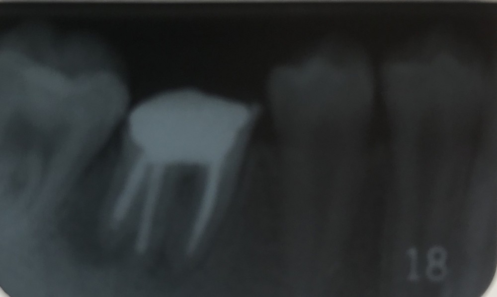 【乳歯抜歯の難しいケース  その2】