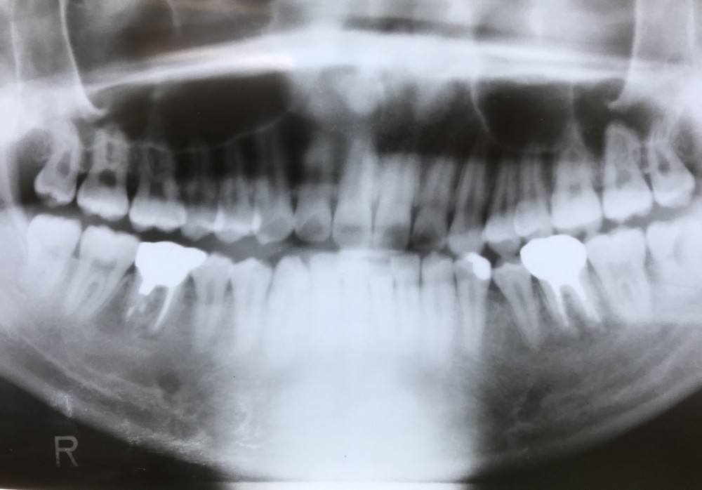 【乳歯抜歯の難しいケース  その2】