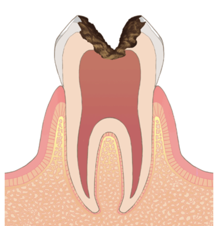 歯の神経を取る『 心配』『不安』