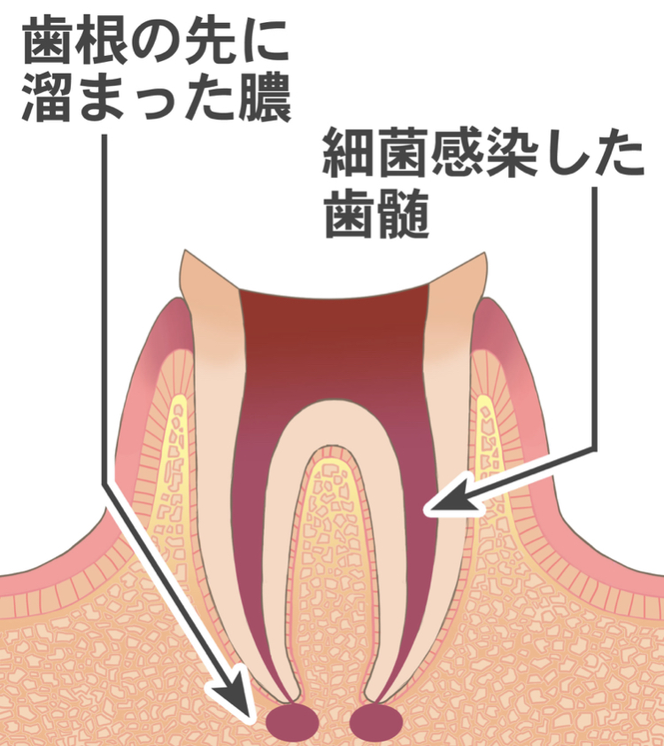 歯の神経を取る『 心配』『不安』