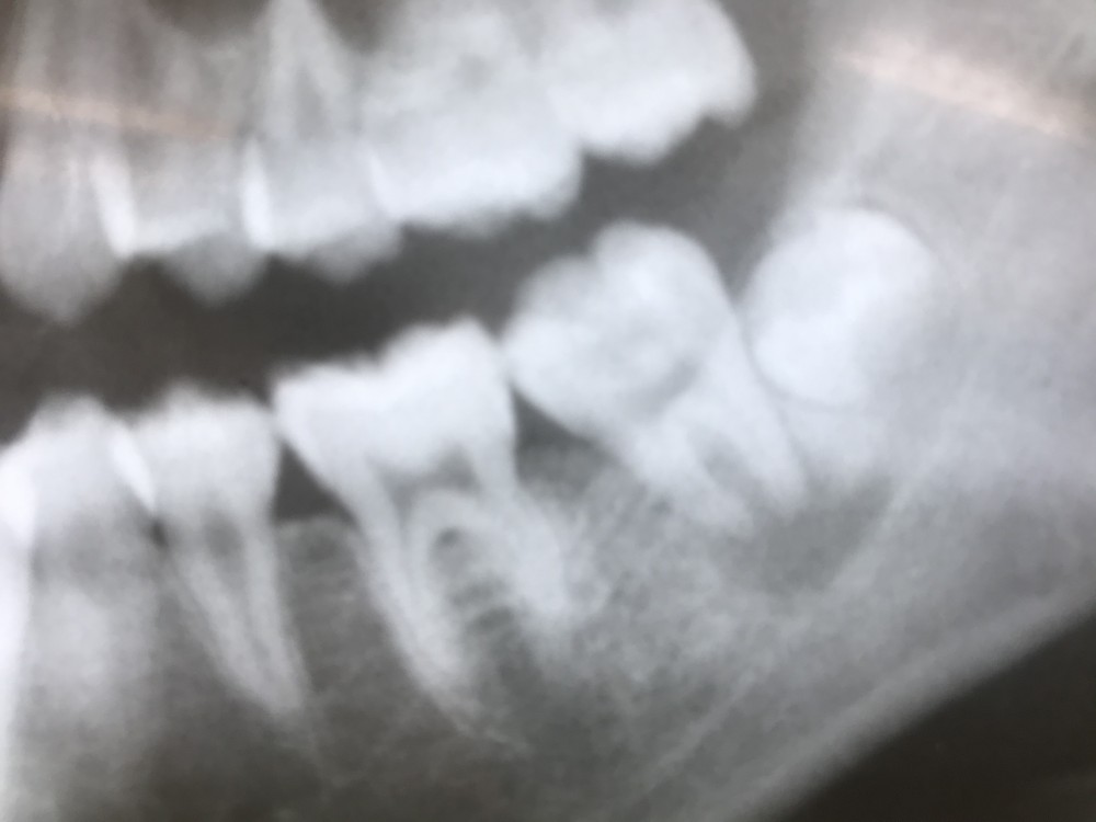 歯の神経を取る『 心配』『不安』
